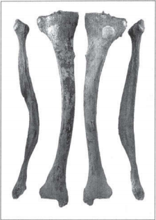 Figure 1: Example of bowed leg bones (tibia and fibula) from the post-medieval Spitalfields population (Cox 1996, 22).